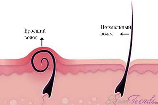 Вросшие волосы на голове
